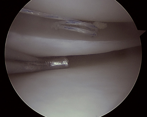 Sutura meniscal