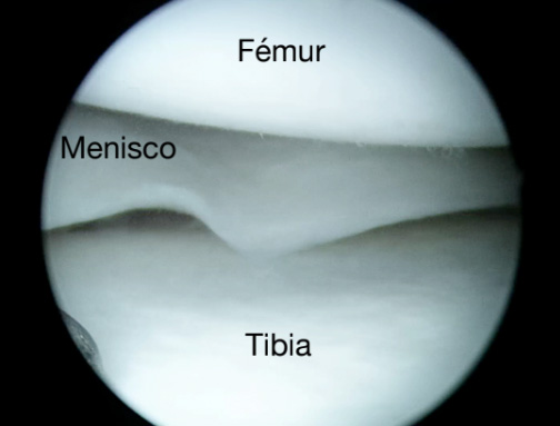 Visió artroscòpica del menisc